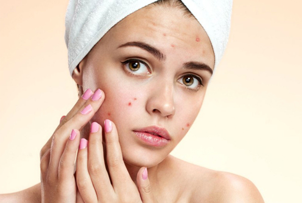 Acne Treatment