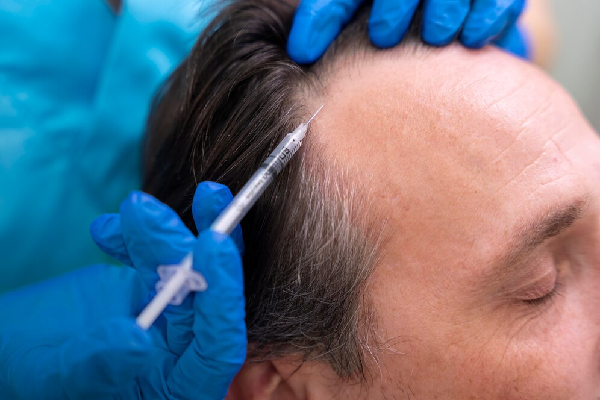 Alopecia Treatment