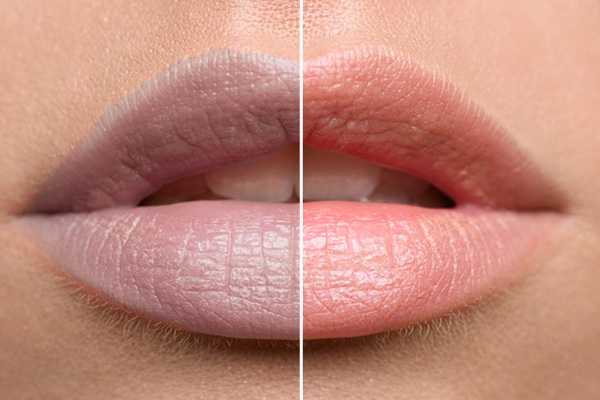 Dark Lips Treatment